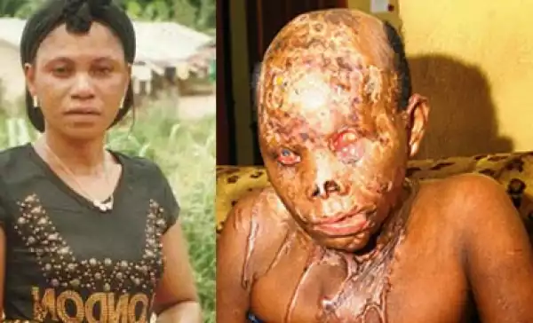 Married Man Jailed 10 Years For Bathing Lover With Acid
